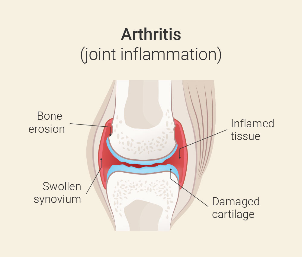 Unterschied Arthrose und Arthritis | Difference osteoarthritis and arthritis