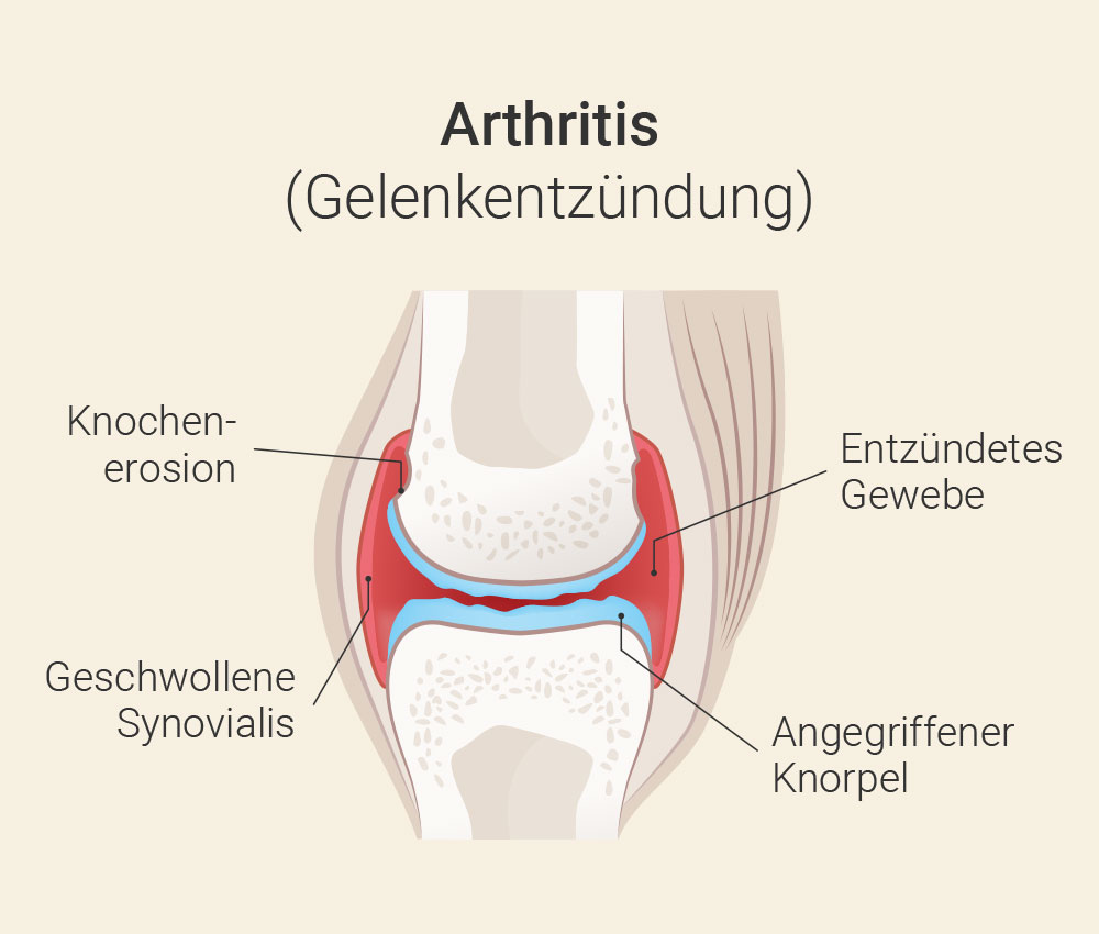 Unterschied Arthrose und Arthritis | Difference osteoarthritis and arthritis