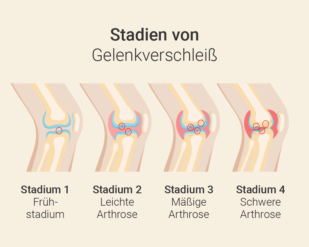 Arthrose­therapie Frankfurt