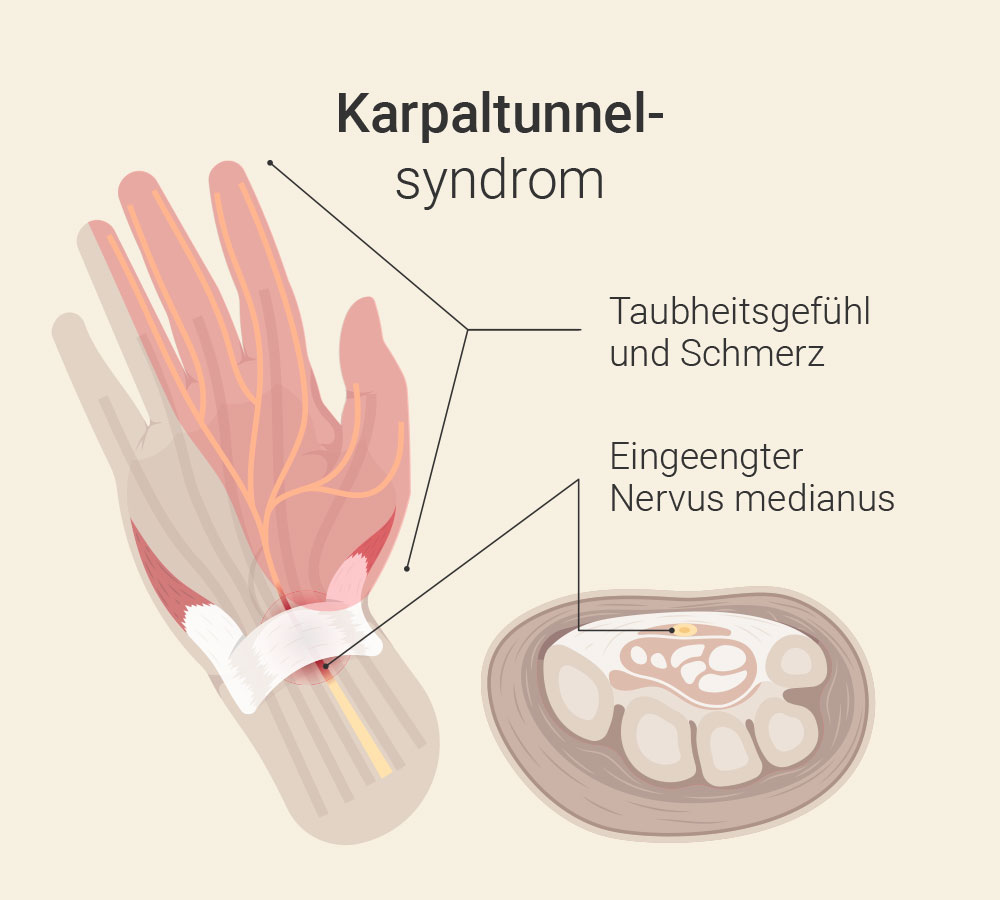 Was tun bei Karpaltunnelsyndrom