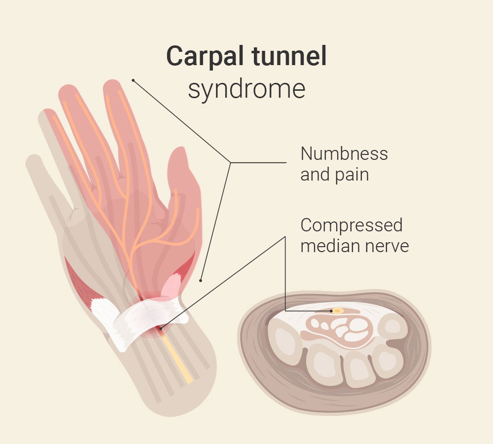 What to do with carpal tunnel syndrome