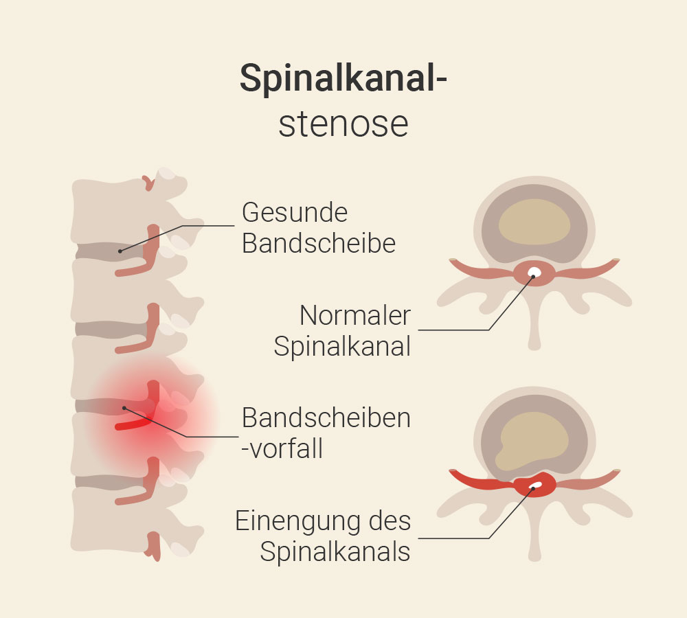 Spinalkanalstenose Beinschmerzen