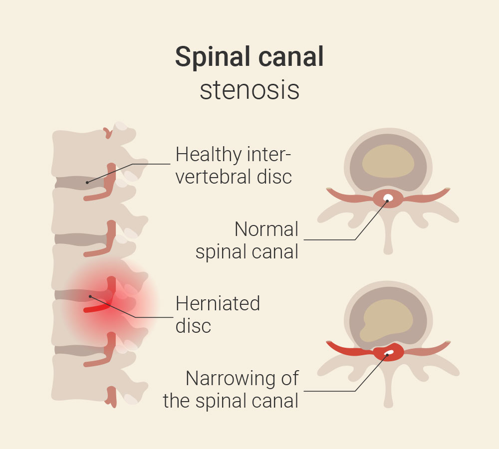 Spinal canal stenosis leg pain